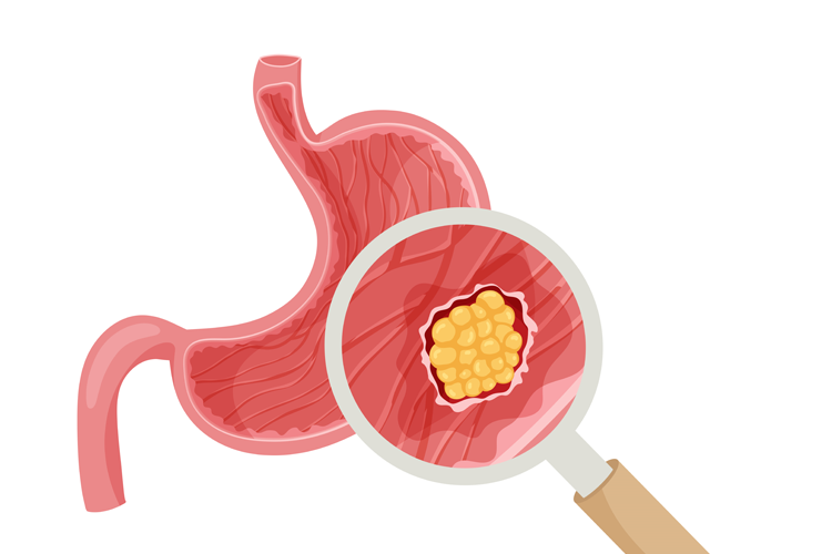 Gastrointestinal Cancer Specialist in Shivaji Nagar