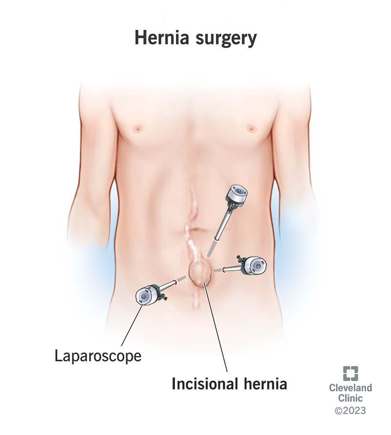 Hernia Surgery in Shivaji Nagar Pune
