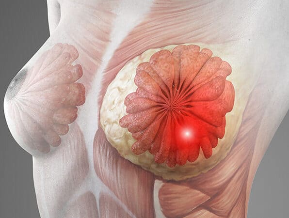 Breast Cancer Doctor in Shivaji Nagar