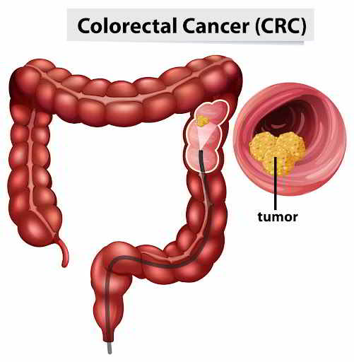 Digestive Cancer Treatment in Shivaji Nagar