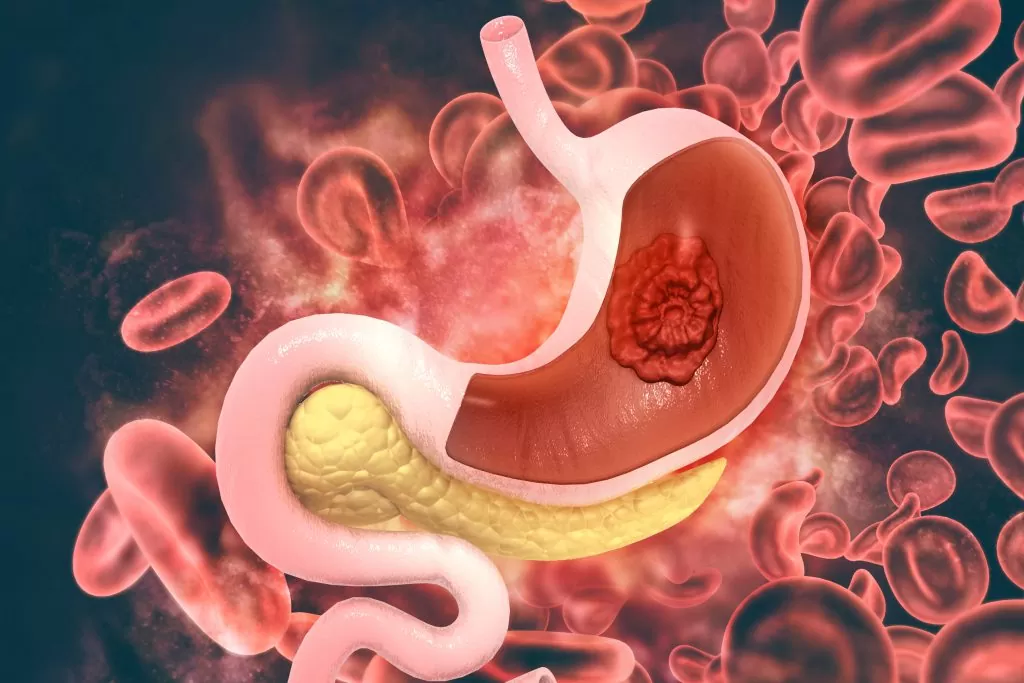Gastrointestinal Cancer Treatment in Shivaji Nagar