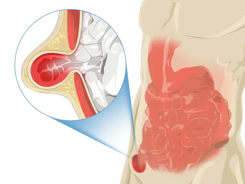 Laparoscopic Hernia Repair in Shivaji Nagar