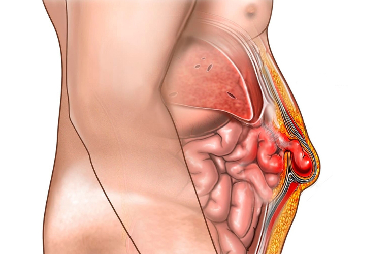 Hernia Repair Surgery in Shivaji Nagar